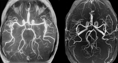 МРТ сосудов головного мозга, где сделать, что показывает