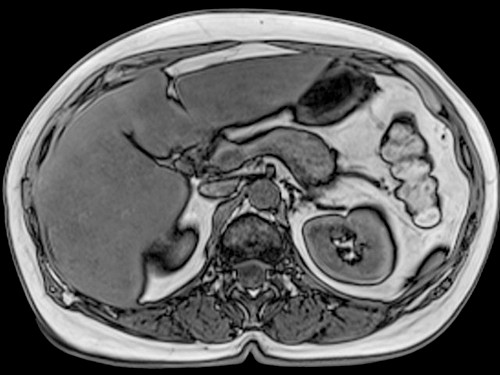 МРТ снимок органов брюшной полости