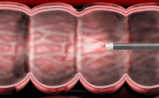 Колоноскопия или мрт