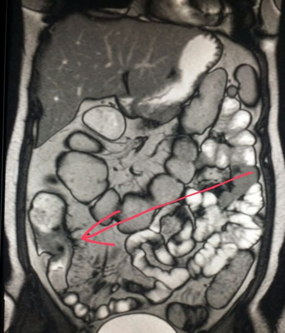 МРТ кишечника