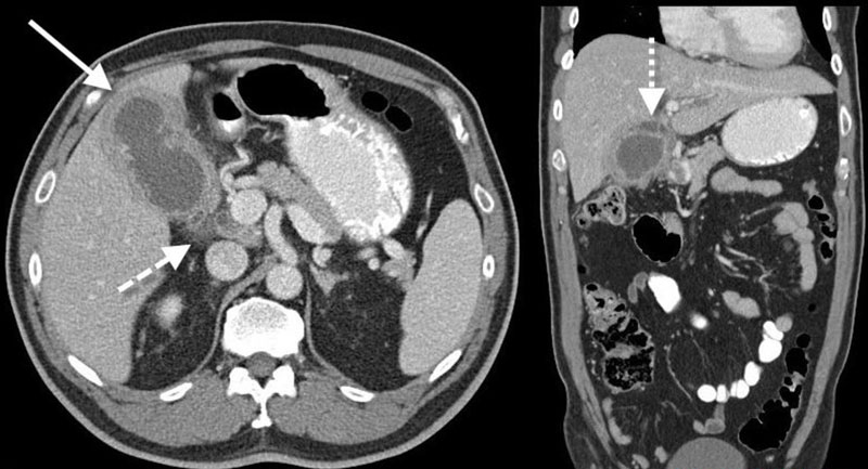 МРТ желчного пузыря