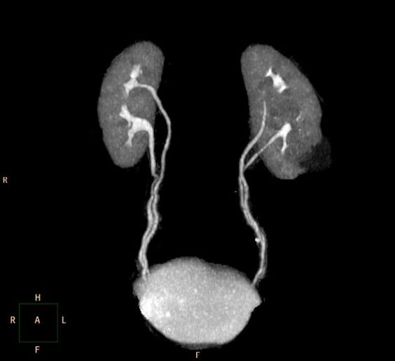 МРТ мочеточников