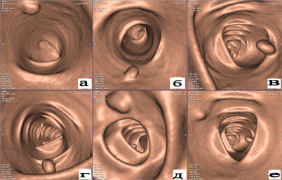 Виртуальная МРТ колоноскопия