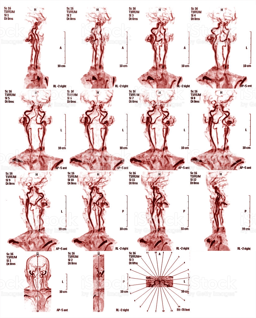 МРТ артерий шеи