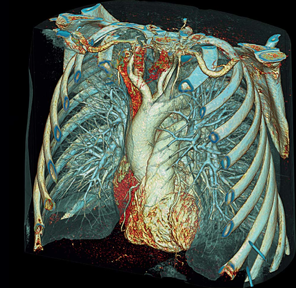 Томография органов грудной клетки, что показывает