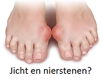urinezuur jicht