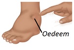 vochtophoping onder oog