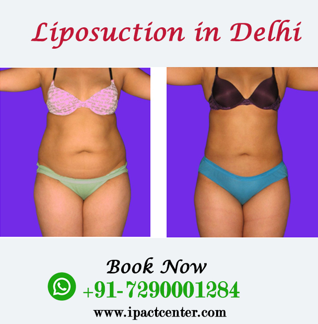 liposuction in Delhi liposuction in Delhi
