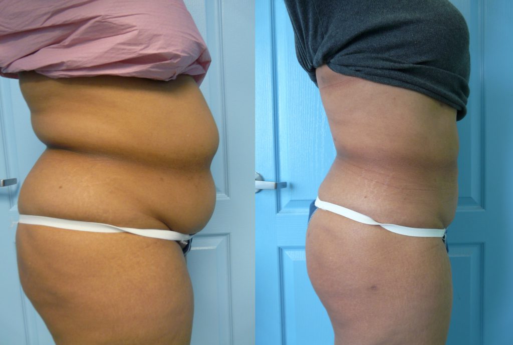 liposuction in Delhi liposuction in Delhi