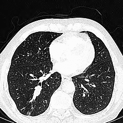 Unexpected diagnosis resulting from presentation with Chronic Obstructive Pulmonary Disease (COPD) exacerbation