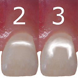 How to score white spot lesions according to Gorelick´s index.