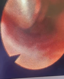 Peroperative bronshoscopy showing the tracheostomy tube within the left main bronchus, causing an inflammatory reaction and conforming to the bronchial wall.