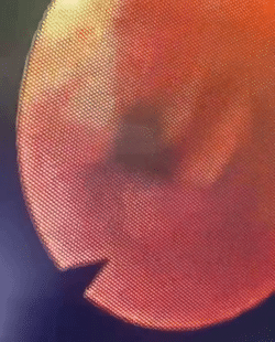 Peroperative bronchoscopy showing the Intraoperative bronchoscopy performed through the tracheostomy orifice to facilitate the forceps extraction of a migrated tracheostomy tube lodged in the left main bronchus