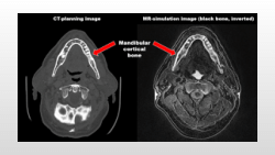 ISMRM 2025 Poster - Morphometric analysis of black bone MRI for radiation-induced bone injury in the head and neck