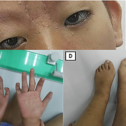 Axial skeletal survey findings in a Filipino teenage female with Ohndo syndrome SBBYS variant