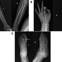 Appendicular skeletal survey findings in a Filipino teenage female with Ohndo syndrome, SBBYS variant