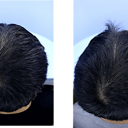 Hair follicle status before and after hyperbaric oxygen therapy in subjects