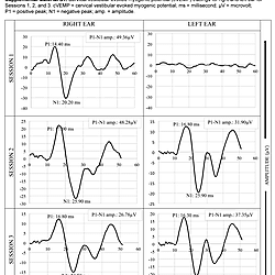 cVEMP & oVEMP recovery in Susac syndrome (Suman et al., 2022)