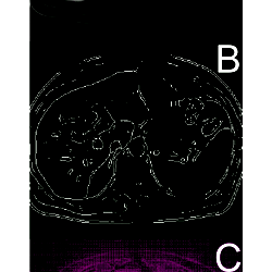 Active contours algorithm and the Gradient Vector Flow map.