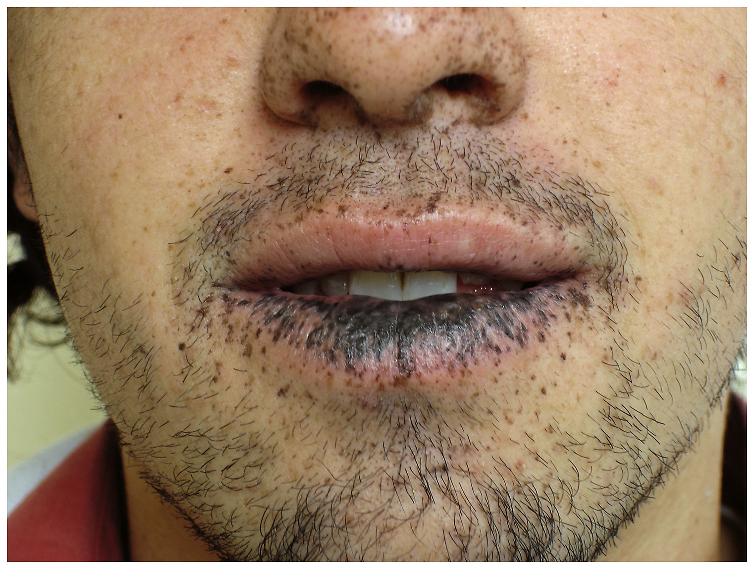 oral melanotic Labial melanotic macule (brown spot on lip) (Stony Brook Case 1)  dermatology dermatopathology main image 1