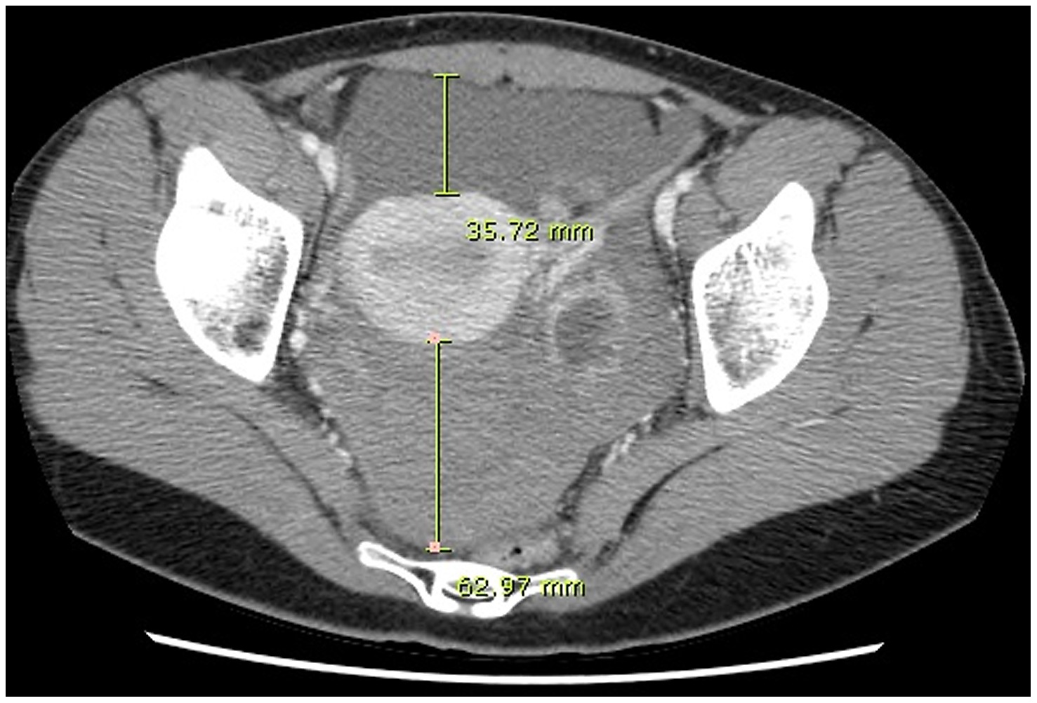 Ct Quantification Of Hemoperitoneum