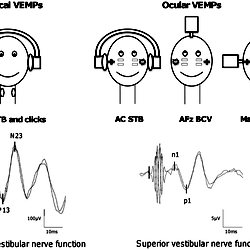 Presentation of the five VEMP tests.