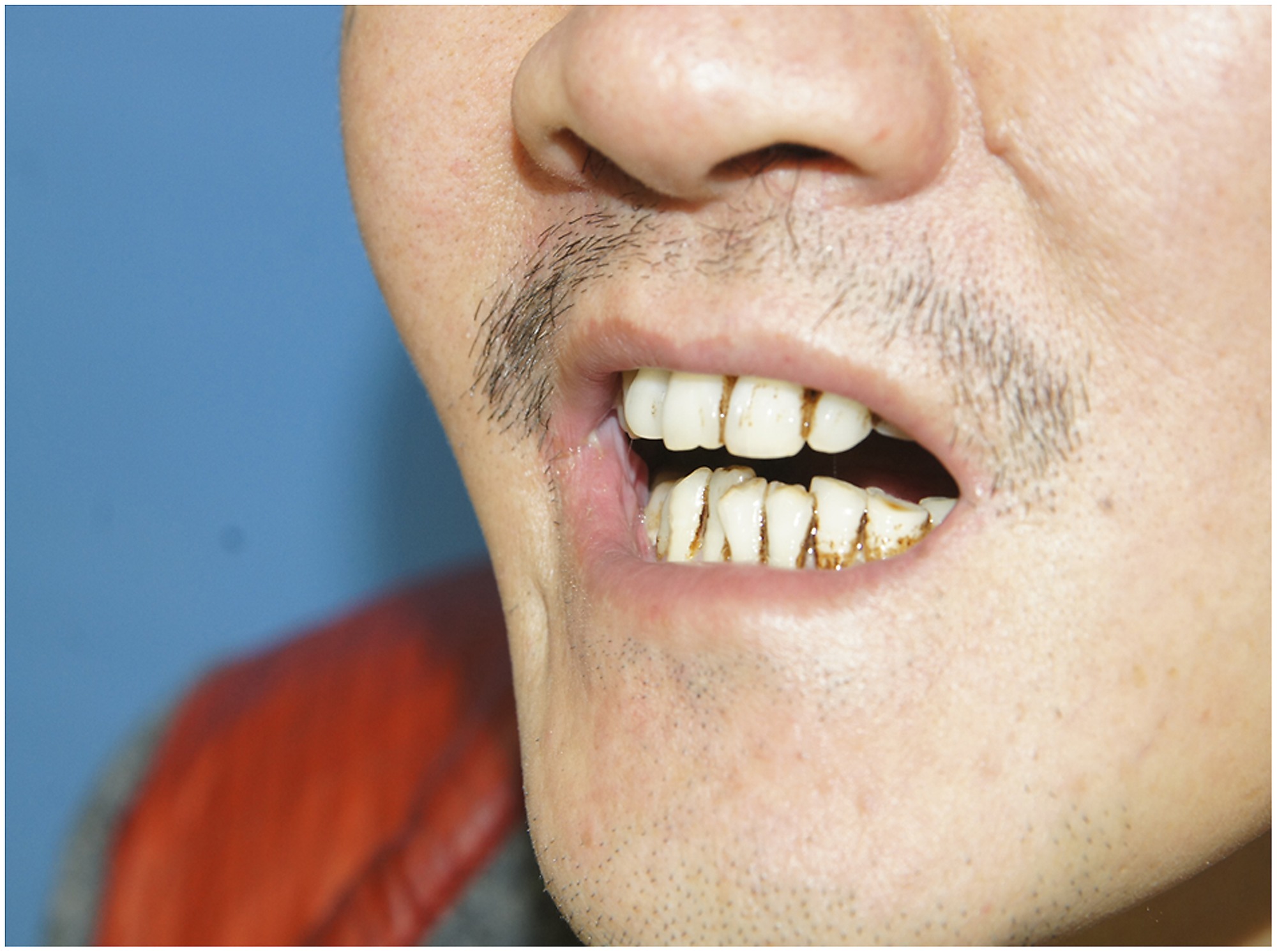 preoperative view of trismus due to right buccal cancer and trismus