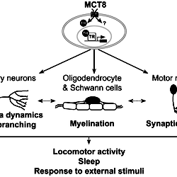 A proposed model for the mechanism underlying MCT8 deficiency.