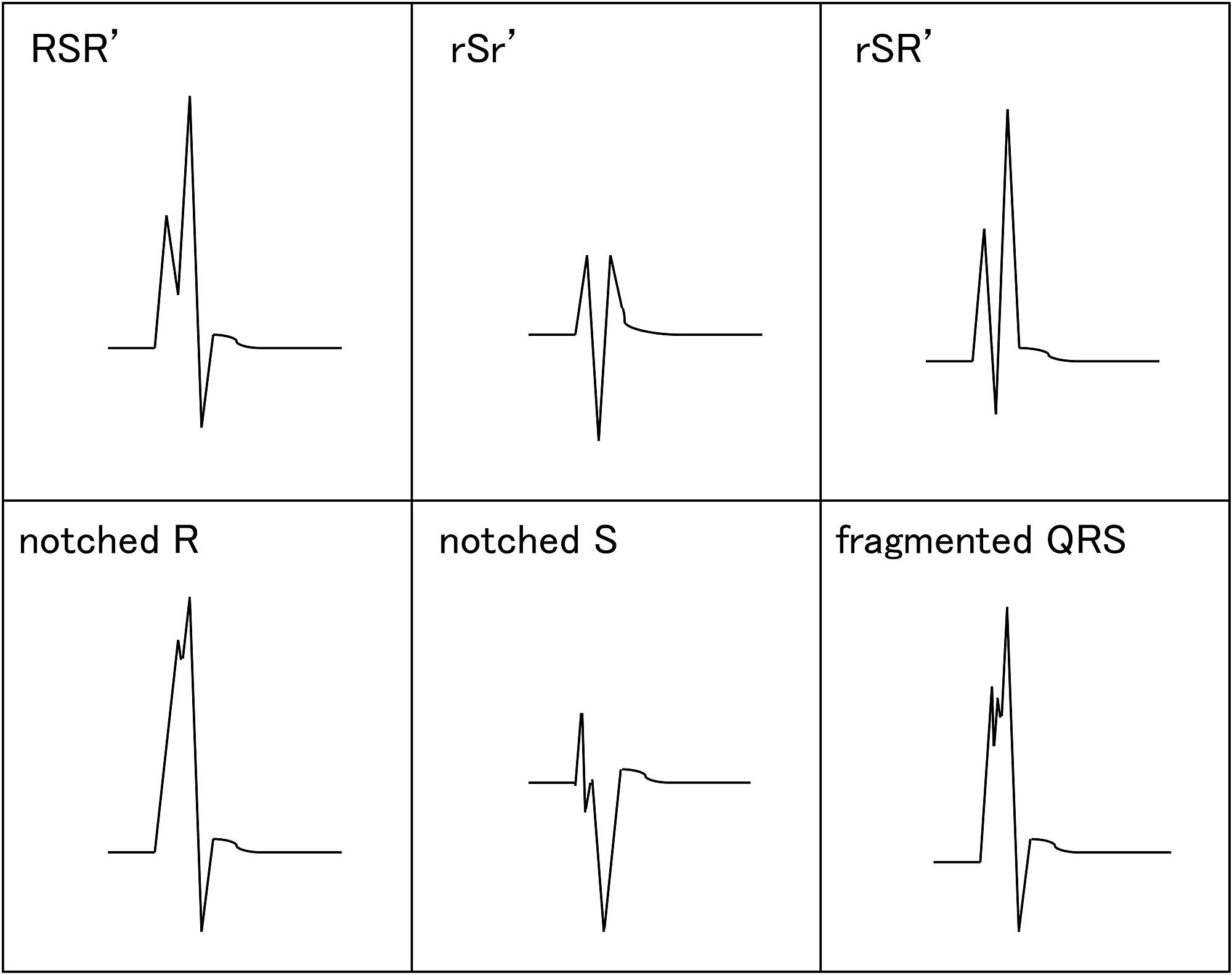 Is Your Upside Down Qrs Complex A Silent Killer? - mpvuym9