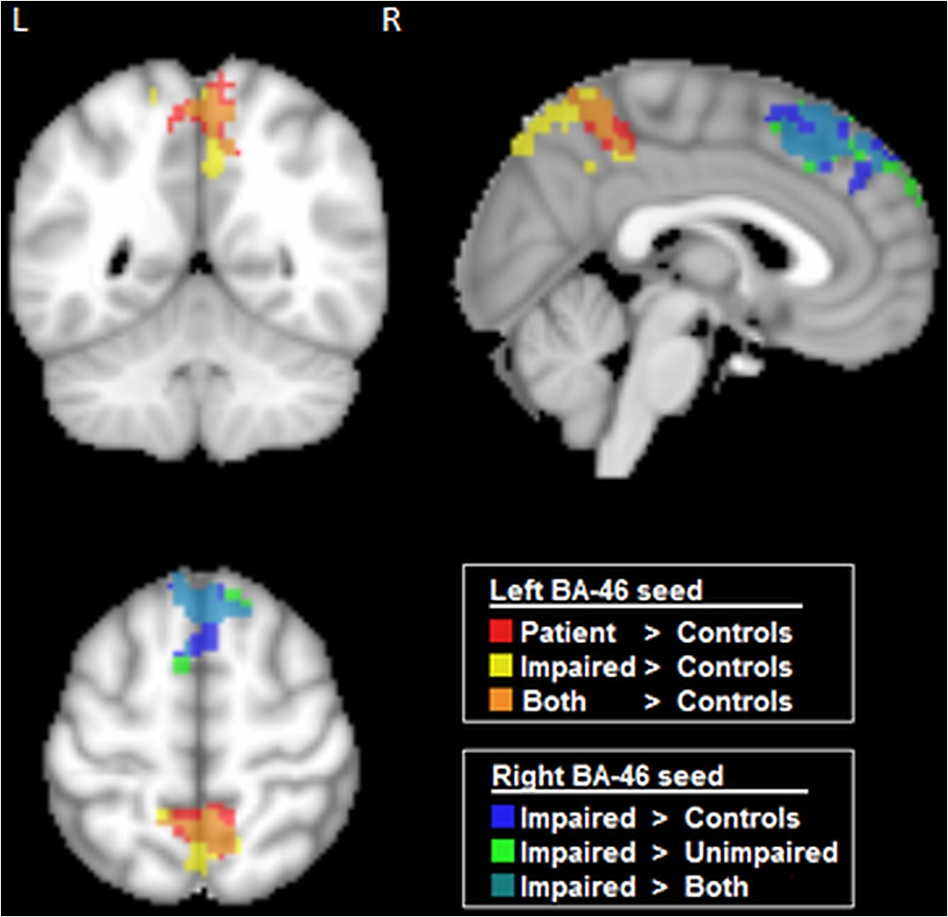 Brain Regions Showing Significant Differences In Seed Based Functional Connectivity Maps Between Control And Patient Populations