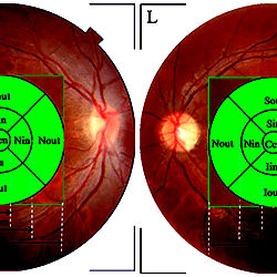 Early Treatment Diabetic Retinopathy Study (ETDRS) chart of the right ...
