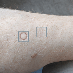Skin marks.
