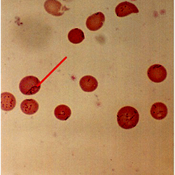 Bartonella bacilliformis seen in a blood film with Giemsa staining