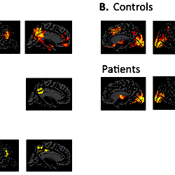 Brain Activation Patterns Of The Whole Brain Analysis Brain Activation Patterns Of The Whole Brain Analysis