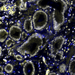 Multiplex imaging of localized prostate tumors reveals changes in the spatial organization of AR-positive cells in the microenvironment