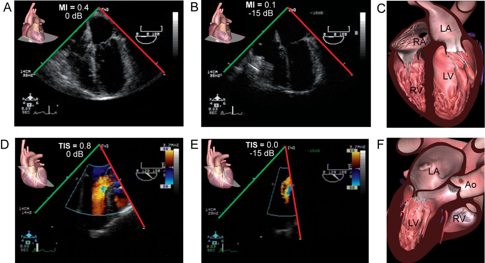 Transmitting power and indices. ME 4C (A–C) and ME long-axis color Doppler (D–F) views show (A, D) transmitting power in decibels (dB). A value of 0 dB specifies the emitting source is at 100% of its power. (B, E) Reduced transmitting power results in negative dB, and both the mechanical index (Ml) and the soft tissue thermal index (TIS) decrease.<em> Abbreviations</em>: 4C, four chamber; Ao, aorta; LA, left atrium; LV, left ventricle; ME, mid-esophageal; RA, right atrium; RV, right ventricle. <i class='fa fa-video-camera' aria-hidden='true'></i></p>