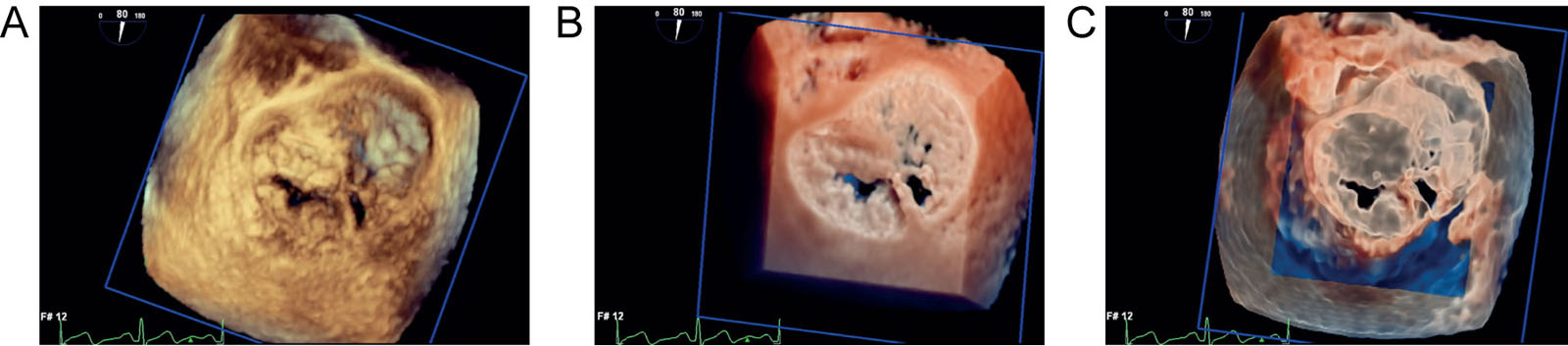 3D image displays. Conventional 3D rendering uses shading techniques to encode voxels based on their distance, grey-level gradient, and texture to generate a display of cardiac structures in 3D. Computer-generated lighting uses shadowing, transparency and opacity effects to create the depth perception. Shown is a 3D dataset of a mitral valve P2 prolapse on a 2D display using different options, such as (A) standard mode, (B) TrueVue® (Philips, Andover, MA) and (C) TrueVue Glass® (Philips, Andover, MA).<em> Abbreviations</em>: 2D, two-dimensional; 3D, three-dimensional <i class='fa fa-video-camera' aria-hidden='true'></i></p>