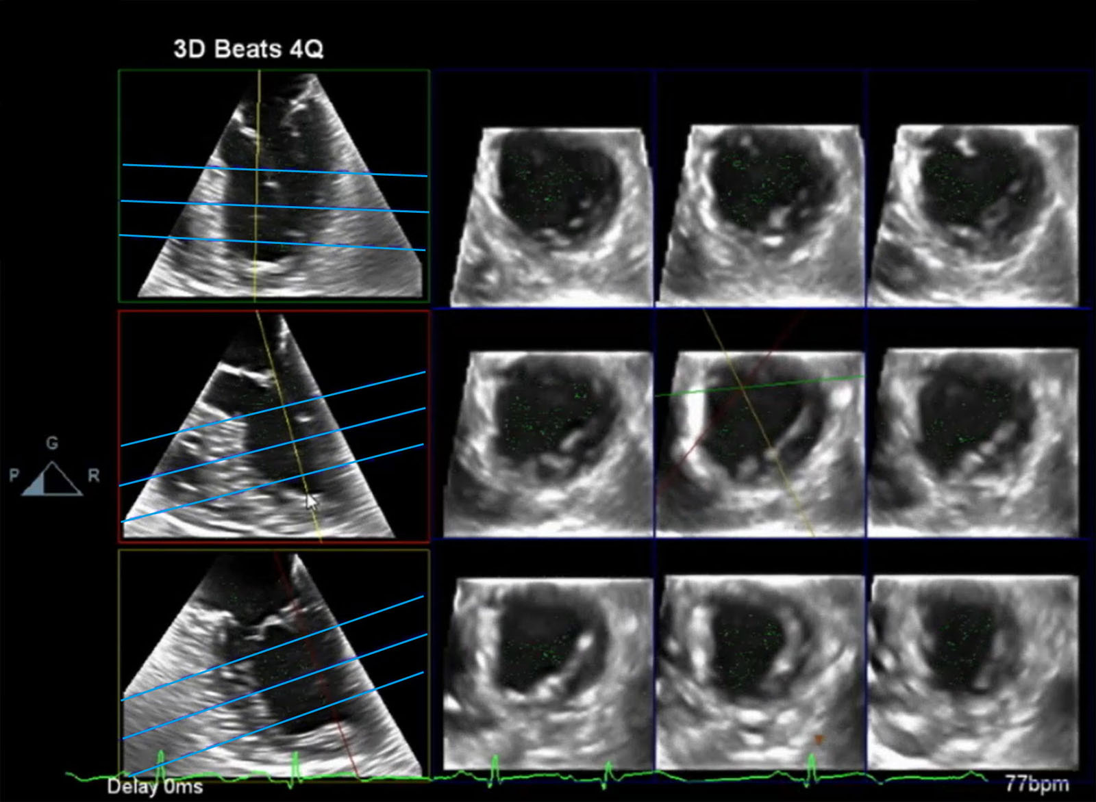 Multi-slice image display. The multi-slice display option cuts a 3D dataset to show multiple 2D images on a single display. Shown is a full volume 3D dataset from a ME 4C view with reconstruction of 2D SAX views at multiple levels. This display option allows the rapid evaluation of RWMA as after coronary revascularisation.<em> Abbreviations</em>: 2D, two-dimensional; 3D, three-dimensional; 4C, four-chamber; ME, mid-esophageal; RWMA, regional wall motion abnormalities; SAX, short-axis. <i class='fa fa-video-camera' aria-hidden='true'></i></p>