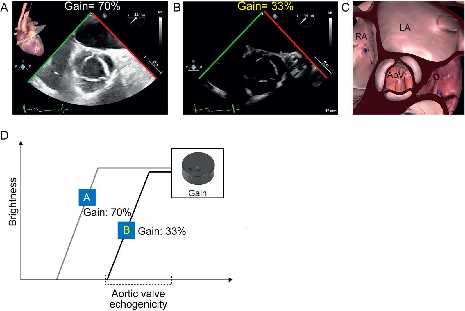 Overall gain control. (A-C) ME AoV short-axis view showing the effect of varying gain on the visual quality of the image by comparing (A) the gain of 70% with (B) the lower gain of 33%. (D) Relationship between brightness and AoV echogenicity, which represents the strength of the reflected signal from a given location in the patient. Higher gain value means that weaker signals (left of the x-axis) are given a high brightness. With a gain of 70%, the signal of most of the AoV is saturated (white), while a gain of 33% offers more contrast, the slope being located horizontally within the AoV echogenicity range in the image as represented by the figure. Echo signals below the chosen minimal threshold will appear as black pixels, while those exceeding the maximal range will appear uniformly as dense white pixels. Adjusting total gain changes the position of the center of the slope relative to the available range enhancing brightness within that range.<em> Abbreviations</em>: AoV, aortic valve; LA, left atrium; ME, mid- esophageal; RA, right atrium. <i class='fa fa-video-camera' aria-hidden='true'></i></p>