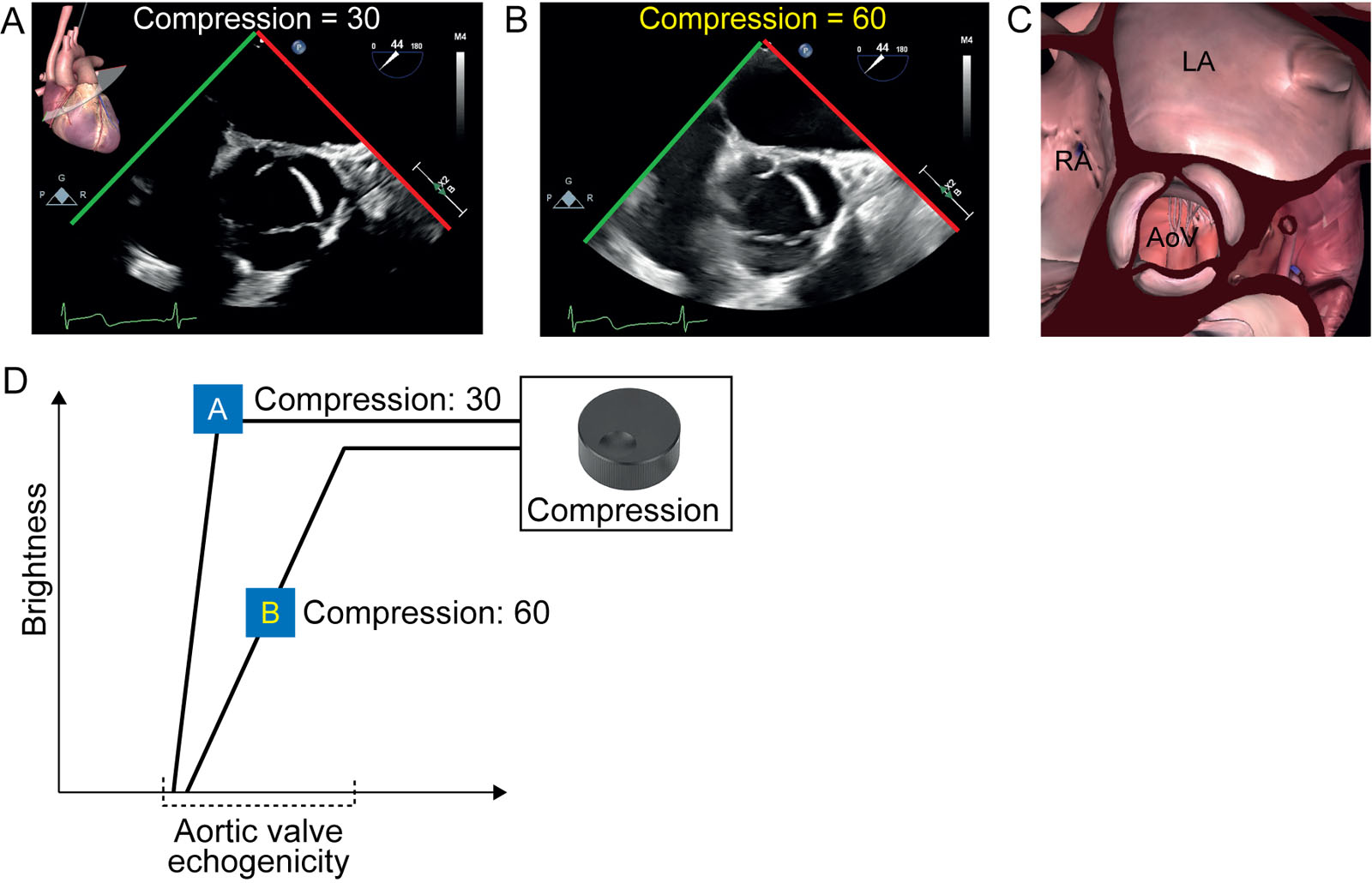Dynamic range compression. (A-C) ME AoV short-axis views show the effect of varying compression adjustments on the visual quality of the image by comparing (A) the compression of 30 with (B) the higher compression at 60. (D) Any echogenicity (x axis) value smaller than the value of the foot of the slope, or greater than the value under the top of the slope will not be visualized as they will appear black or white, respectively. However, all image areas that have an echogenicity value that fall directly under the slope on the x axis are adequately visualized, as they have a different brightness (y axis) value than other image areas of different echogenicity. Therefore, a dynamic range compression of 30 corresponds to a narrower range of echogenicity being adequately visualized, while a value of 60 will allow for a wider range of echogenicity being adequately visualized. These settings correspond to a narrower and a wider dynamic range,<em> Abbreviations</em>: AoV, aortic valve; LA, left atrium; ME, mid-esophageal. RA, right atrium. <i class='fa fa-video-camera' aria-hidden='true'></i></p>