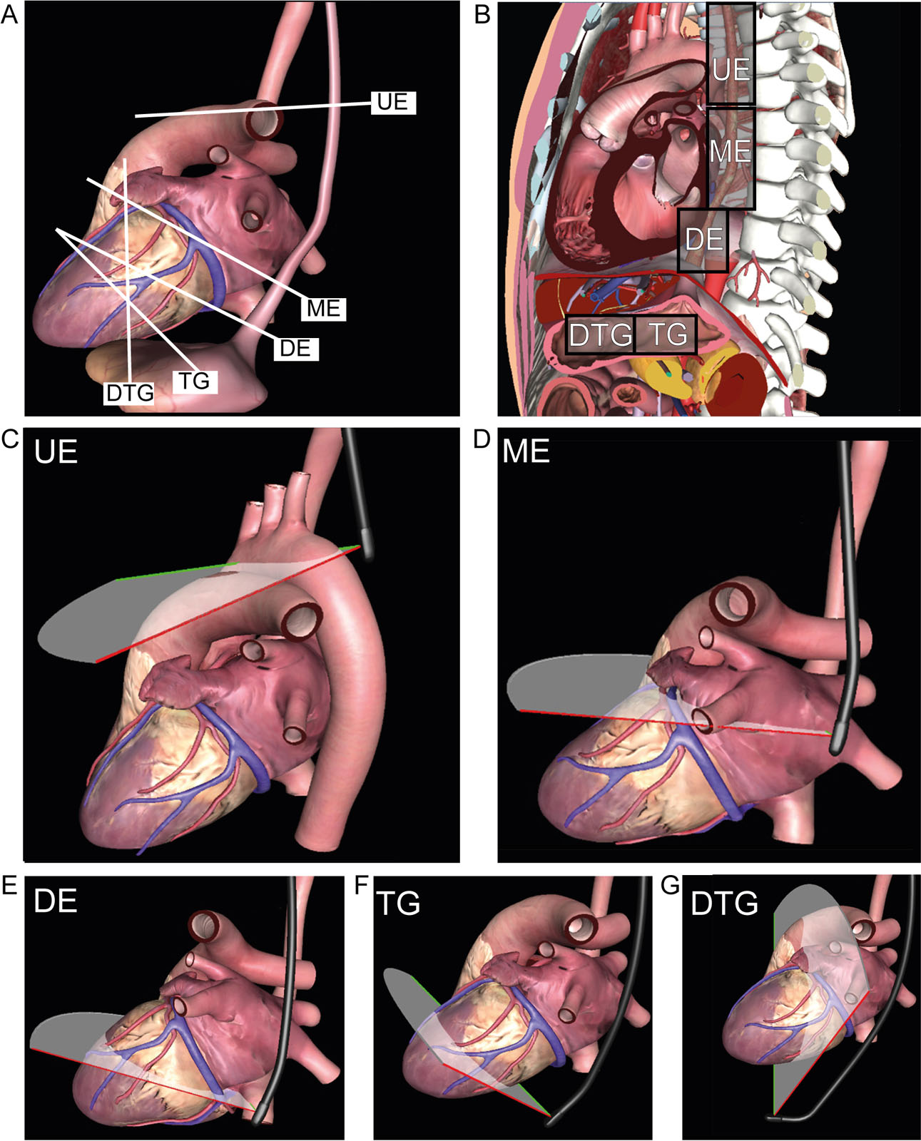 Triplane Multiplane TEE imaging. (A) Simultaneous triplane imaging with the primary imaging plane as the ME 4C view at 4°, and the secondary imaging planes as the ME MC view at 64° and the ME LAX view at 124°.<em> Abbreviations</em>: 4C, four-chamber; LAX, long-axis; ME, mid-esophageal, MC, mitral commissural; TEE, transesophageal echocardiography.<i class='fa fa-video-camera' aria-hidden='true'></i>