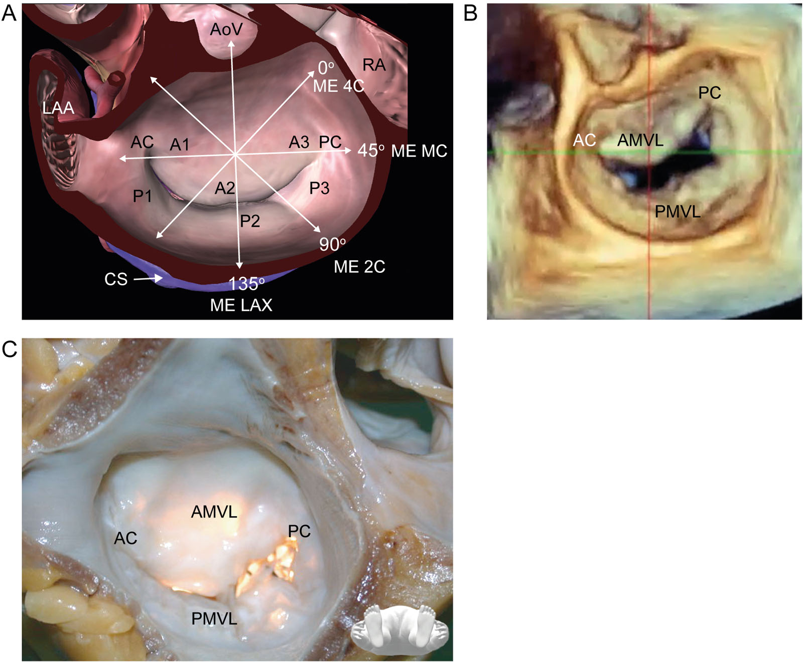 Mitral valve. (A) This is a schematic diagram of the MV with labeled leaflet scallops and segments. (B, C) Corresponding 3D en-face and anatomic images of the MV. The region of the MV leaflets that appear in a 2D image varies with the relation of the heart to the esophagus.<em> Abbreviations</em>: 2C, two-Chambers; 2D, two-dimensional; 3D, three-dimensional; A, anterior MV segments; AC, anterior commissure; AMVL, anterior MV leaflet; AoV, aortic valve; CS, coronary sinus; LAA, left atrial appendage; LAX, long-axis; MC, mitral commissural; ME, mid-esophageal; P, posterior MV segments; PC, posterior commissure; PMVL, posterior MV leaflet; RA, right atrium. <i class='fa fa-video-camera' aria-hidden='true'></i>