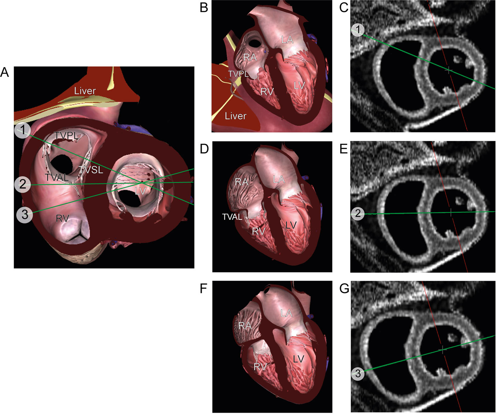 Pitfall in RV basal diameter measurement. (A) TG basal SAX view showing ME RV 4C views at 3 different positions: (B, C) inflow or position#1 (D, E) middle or position #2 and (F, G) and RV outflow tract or position #3. Although there is a similarity in those positions, the RVD will vary depending on its location in the basal RV. The largest RVD at the level of the TVAL (position #2)) should be selected for measurement.<em> Abbreviations</em>: 4C, four-chamber; LA, left atrium; LV, left ventricle; ME, mid-esophageal; RA, right atrium; RV, right ventricular; RVD, right ventricular diameter; SAX, short-axis; TG, transgastric; TVAL, tricuspid valve anterior leaflet; TVPL, tricuspid valve posterior leaflet; TVSL, tricuspid valve septal leaflet. Adapted from Rudski <sup>41</sup> and Lang et al.<sup>6</sup> <i class='fa fa-video-camera' aria-hidden='true'></i>
