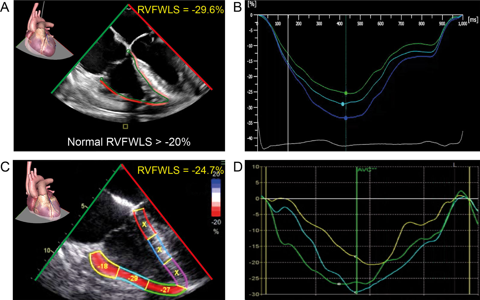 RV systolic strain. ME 4C analyzed with speckle tracking echocardiography shows the RVFWLS averaging the three segments of the free wall using (A, B) Philips and (C, D) GE software.<em> Abbreviations</em>: 4C, four-chambers; ME, mid-esophageal; RV, right ventricular; RVFWLS, right ventricular free wall longitudinal strain. <i class='fa fa-video-camera' aria-hidden='true'></i>