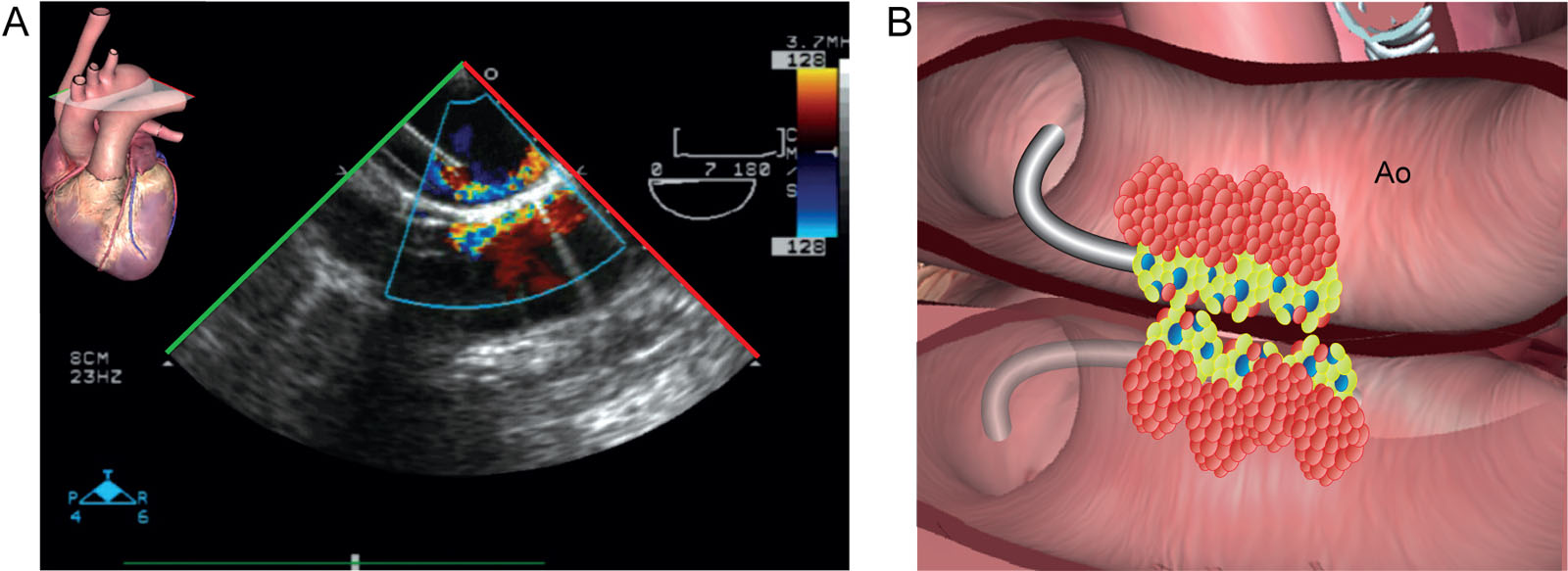 Reverberation. (A, B) This UE aortic arch LAX view at 7° shows reverberation artifacts in both 2D and CFI of the aorta and the aortic cannula.<em> Abbreviations</em>: 2D, two-dimensional; Ao, aorta; CFI, color flow imaging; LAX, long-axis; UE, upper-esophageal.<i class='fa fa-video-camera' aria-hidden='true'></i>