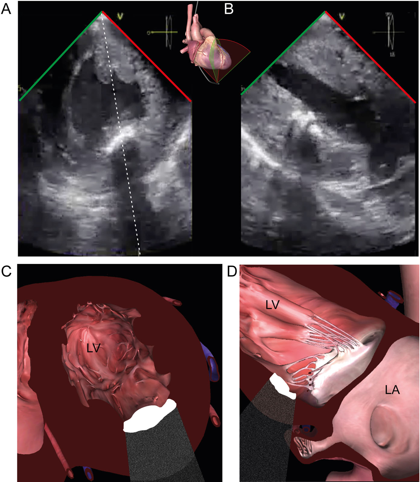Acoustic shadowing. (A, B) This TG biplane view of the LV shows a calcified antero-lateral papillary muscle which causes acoustic shadowing obscuring the far field in both views.<em> Abbreviations</em>: LA, left atrium; LV, left ventricle; TG, transgastric.<i class='fa fa-video-camera' aria-hidden='true'></i>