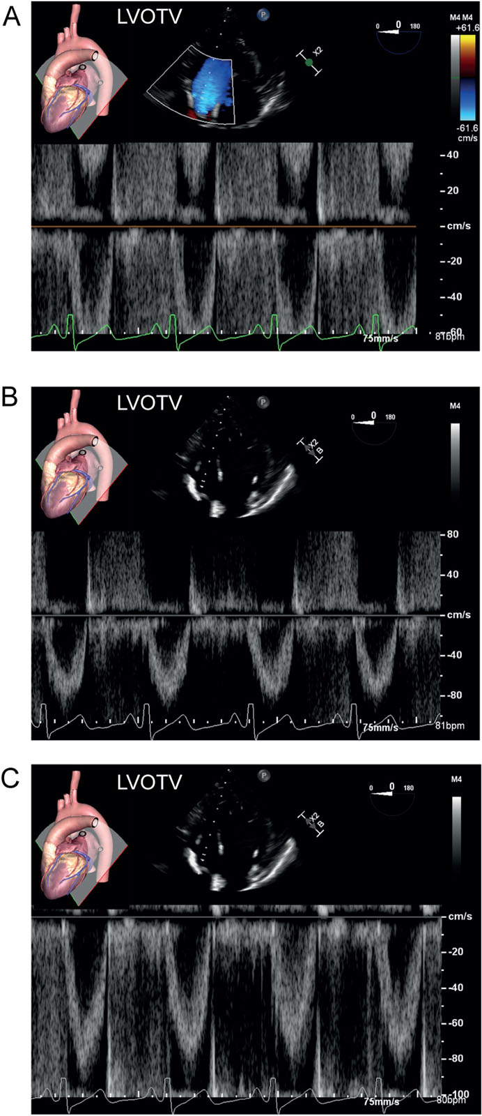 Spectral Doppler aliasing. (A-C) These are PWD signals of the LVOT from a DTG view. (A) The peak negative LVOT velocity (<0 cm/s or baseline) exceeds the upper limit of the velocity scale, and a simultaneous aliasing signal appears on the opposite side of the baseline at the top of the display. (B) Altering the scale peak velocity from –60 to –110 cm/s or (C) shifting the baseline up to a maximum velocity of –100 cm/s eliminates the aliasing artifact.<em> Abbreviations</em>: DTG, deep transgastric; LVOT, left ventricular outflow tract; LVOTV, left ventricular outflow tract velocity; PWD, pulsed-wave Doppler.