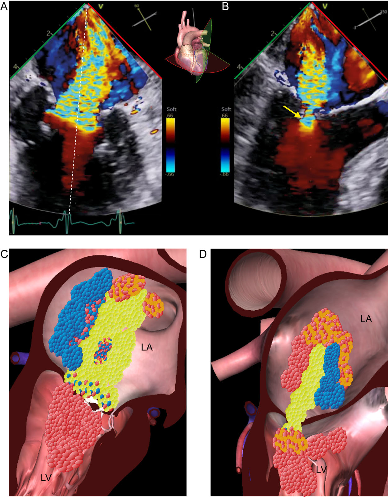 Color Doppler aliasing. (A-D) This is a ME MC biplane view with CFI of the MV. CFI shows mitral regurgitation with blood flow acceleration as aliasing in the LV below the MV. Aliasing appears as an abrupt change in color from red to yellow to light blue (arrow) as velocities exceed the upper limit of the velocity scale. The blue suggest blood flow is going in the opposite direction even when it is still going from LV to LA.<em> Abbreviations</em>: CFI, color flow imaging; LA, left atrium; LV, left ventricle; MC, mitral commissural; ME, mid-esophageal; MV, mitral valve.<i class='fa fa-video-camera' aria-hidden='true'></i>