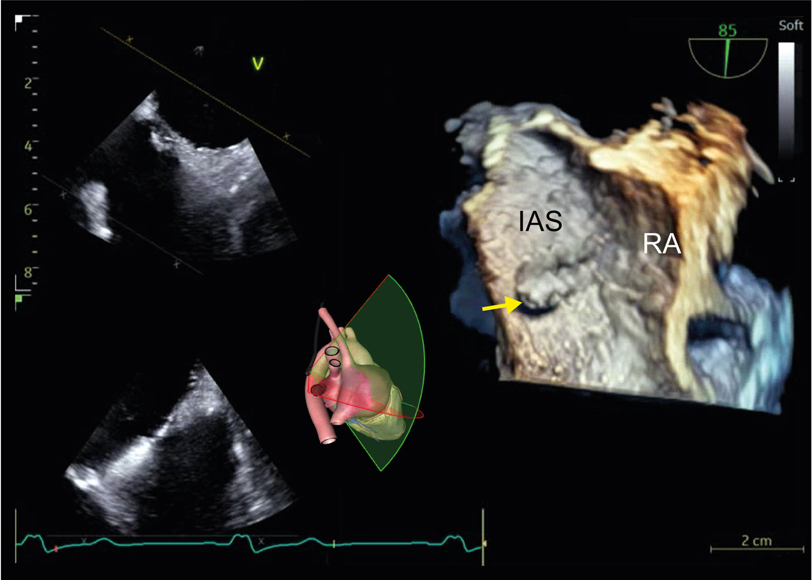 Dropout. These are ME biplane and 3D views of the IAS in a single display. There is a false appearance of tissue deficiency in the fossa ovalis (arrow) because of dropout artifact in the 3D image from the RA perspective. When the structure alignment is not completely perpendicular to the US beam, some reflected echo signals reflect away from the transducer, resulting in the loss of image.<em> Abbreviations</em>: 3D, three-dimensional; IAS, interatrial septum; ME, mid-esophageal; RA, right atrium; US, ultrasound.<i class='fa fa-video-camera' aria-hidden='true'></i>