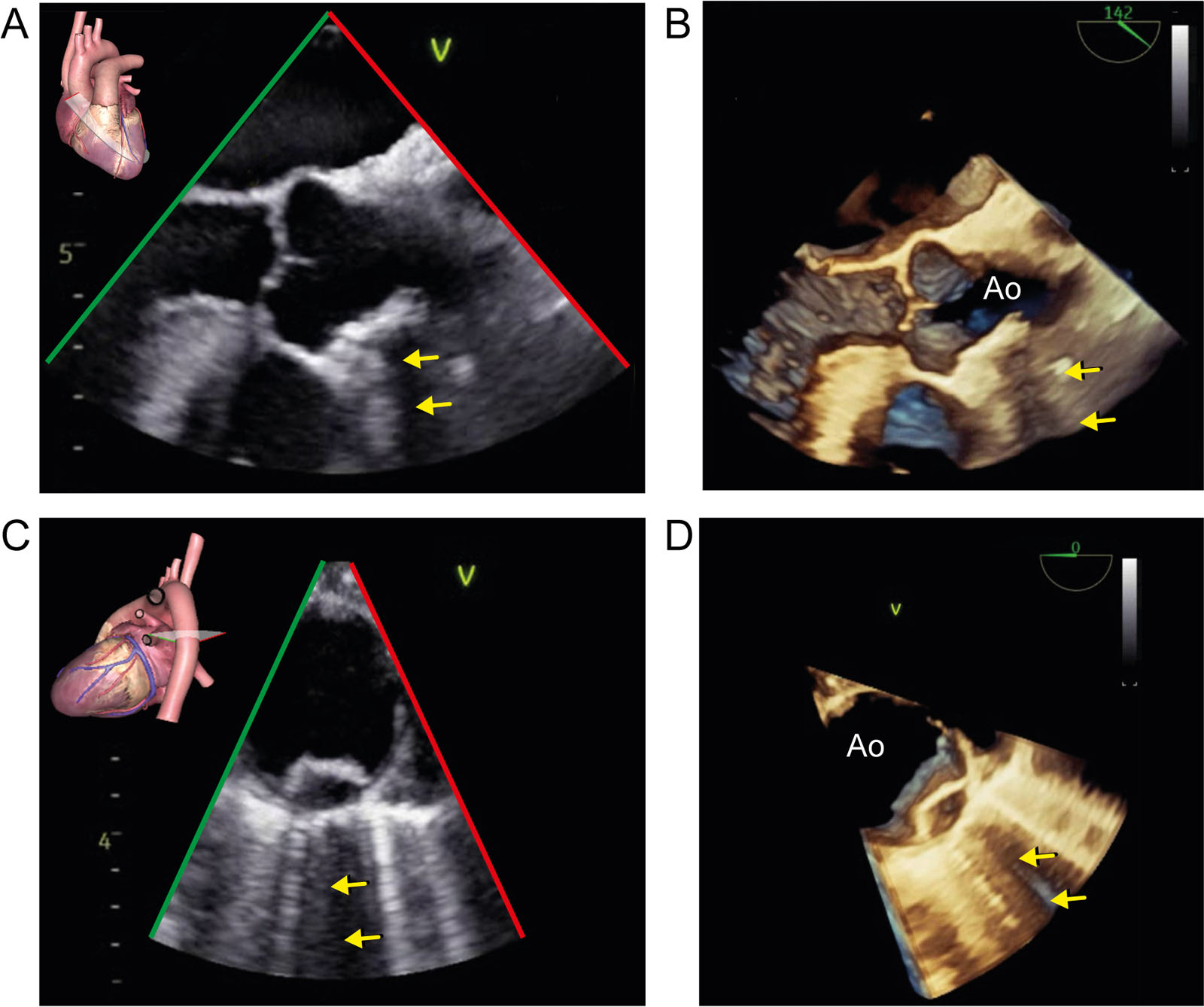 Acoustic Shadowing. (A, B) These 2D and 3D ME AoV LAX views show a large calcified atheromatous plaque from the sinus tubular junction into the ascending aorta causing acoustic shadowing (arrow) in both images. (C, D) These 2D and 3D ME SAX views of the descending thoracic aorta show an atheromatous plaque in the descending thoracic aorta, also causing acoustic shadowing (arrows) in both images. Note also the ring-down or B lines in the lung on both sides of the acoustic shadowing.<em> Abbreviations</em>: 2D, two-dimensional; 3D, three-dimensional; Ao, aorta; AoV, aortic valve LAX, long-axis; ME, mid-esophageal; SAX, short-axis.<i class='fa fa-video-camera' aria-hidden='true'></i>